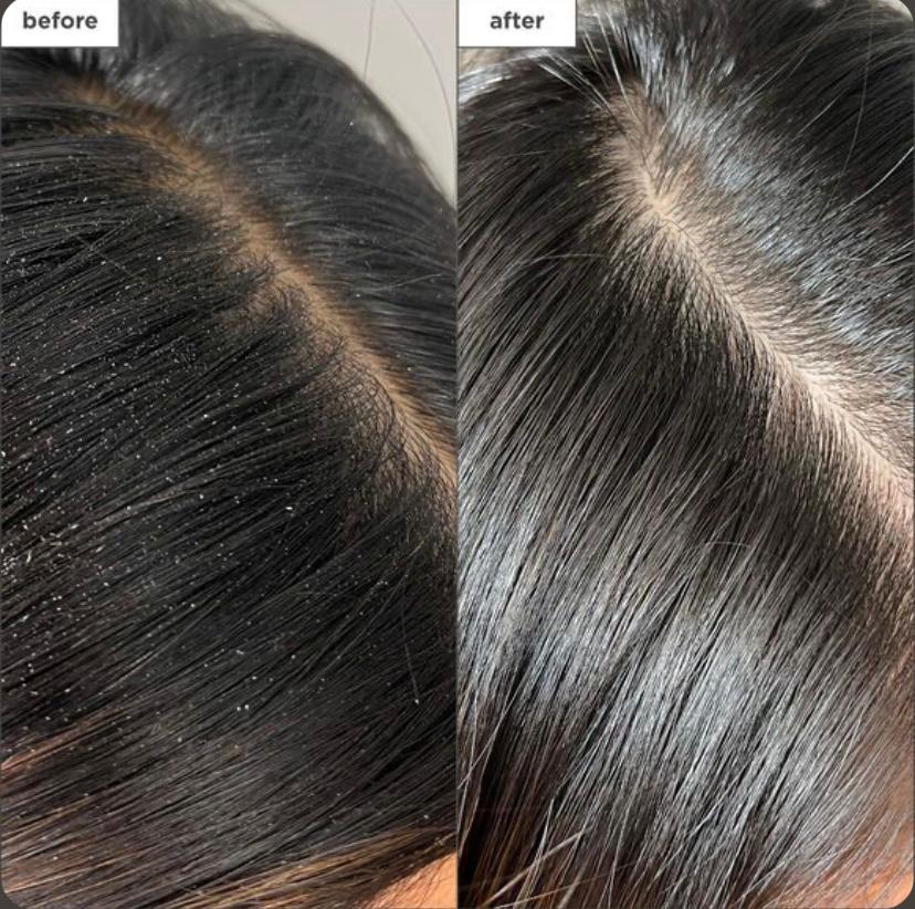 EXFOLIO – SCALP PEELING