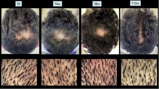 REVITA – ANTI-HAIR LOSS LOTION